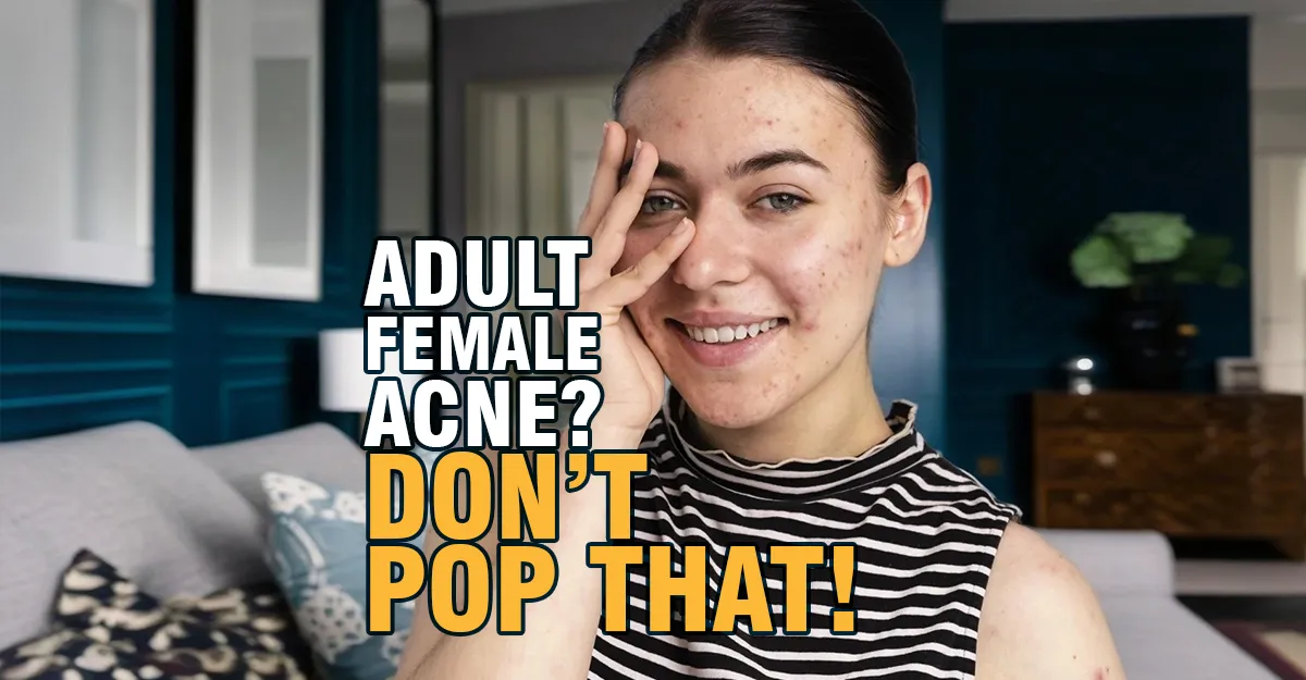 Adult Female Acne: Causes & 5 Natural Treatments