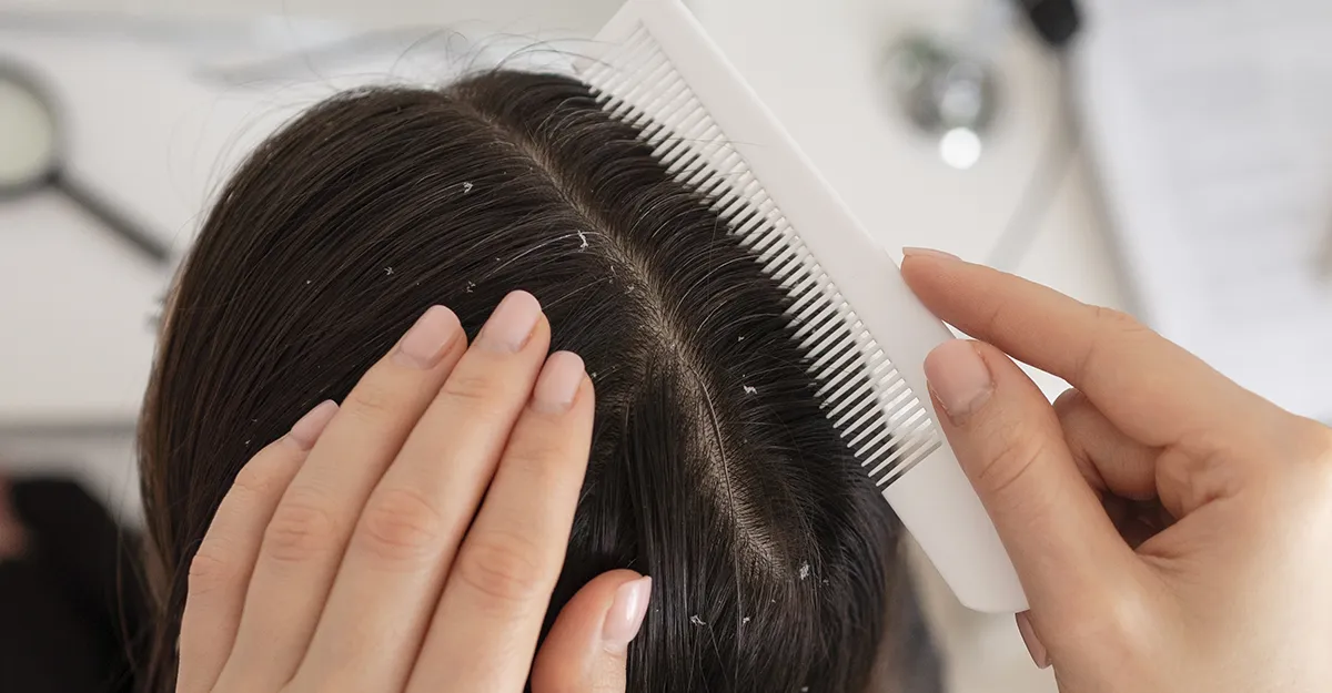 Dandruff visible in hair and scalp