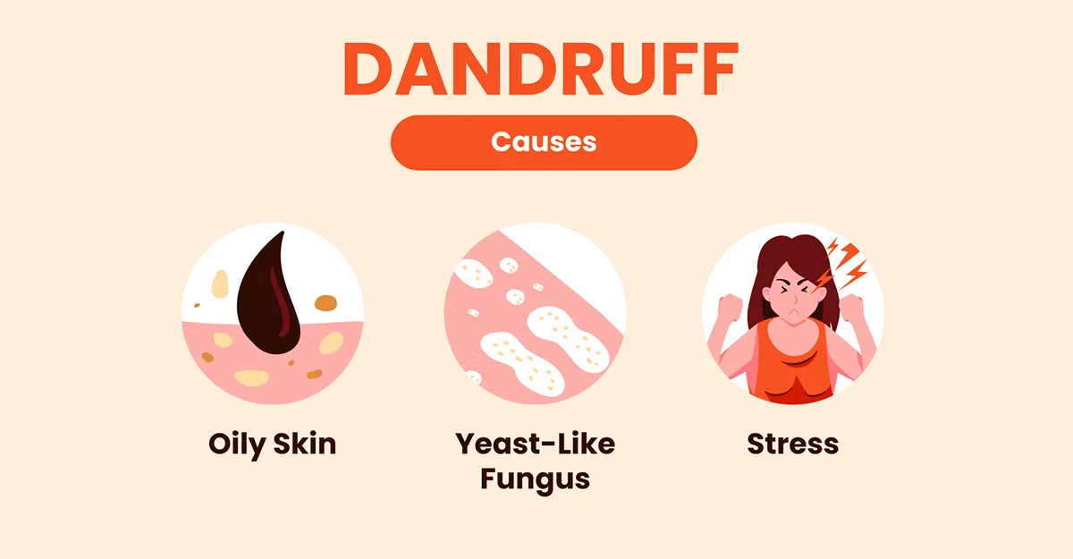 Common causes of Dandruff