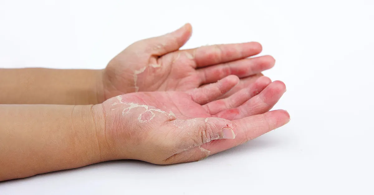 representative image of hands with hand eczema